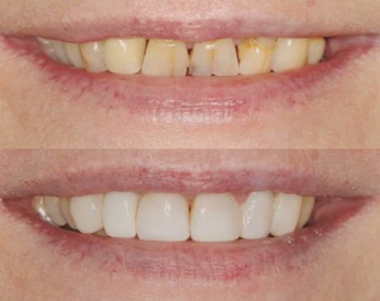 Tooth whitening and smile design