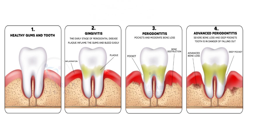 Gingivitis in Stages